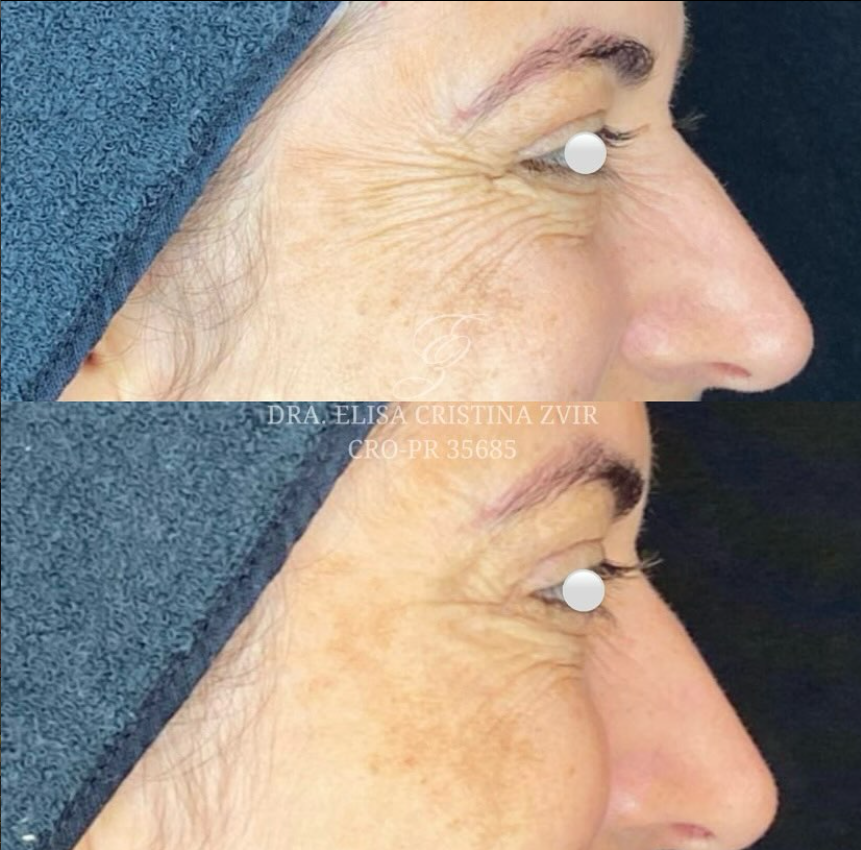 Resultado de perfil de harmonização facial