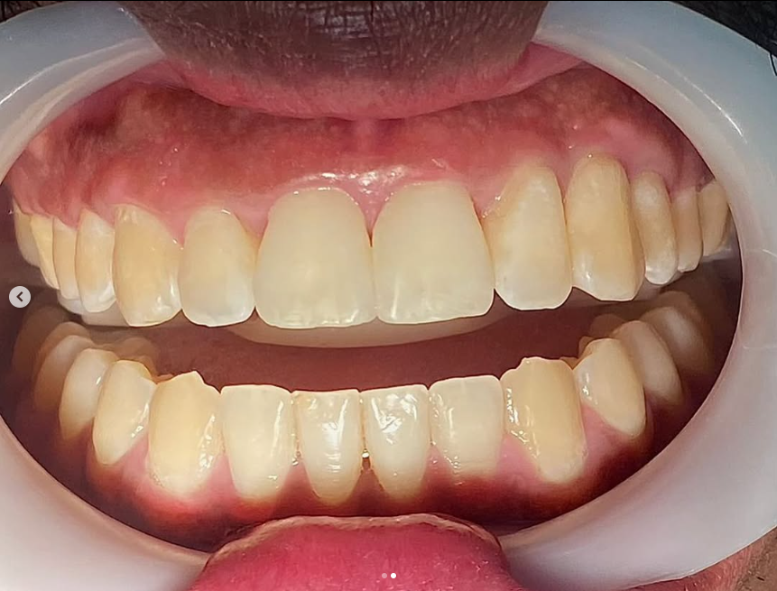 Sorriso depois do tratamento